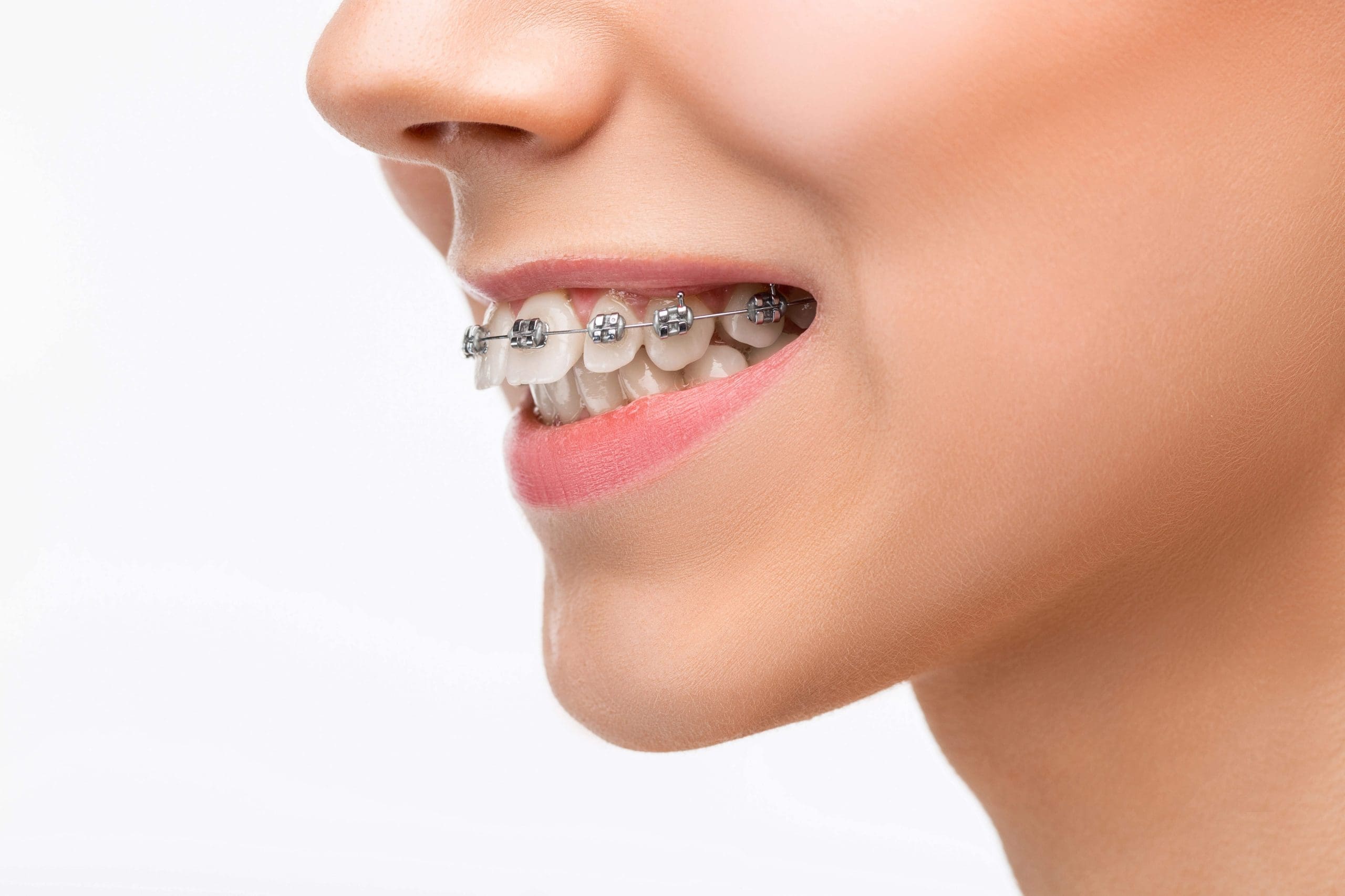 Invisalign for Overbite: Straighten Your Smile