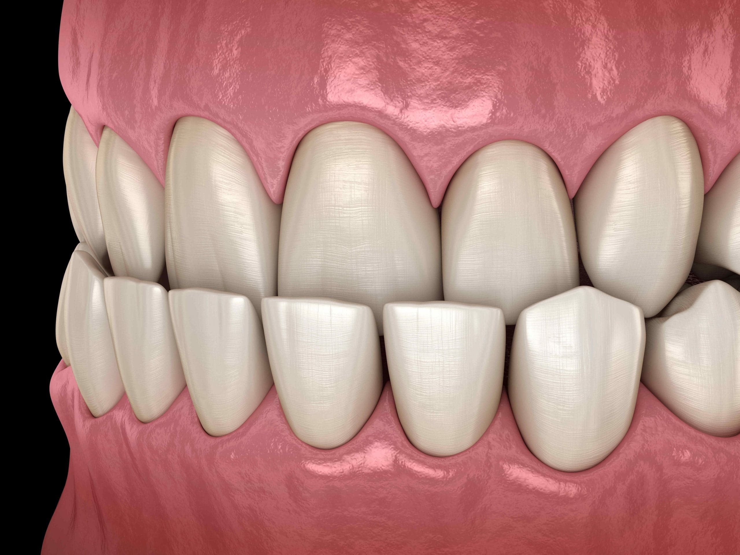 Invisalign for Underbite: Align Your Bite Safely