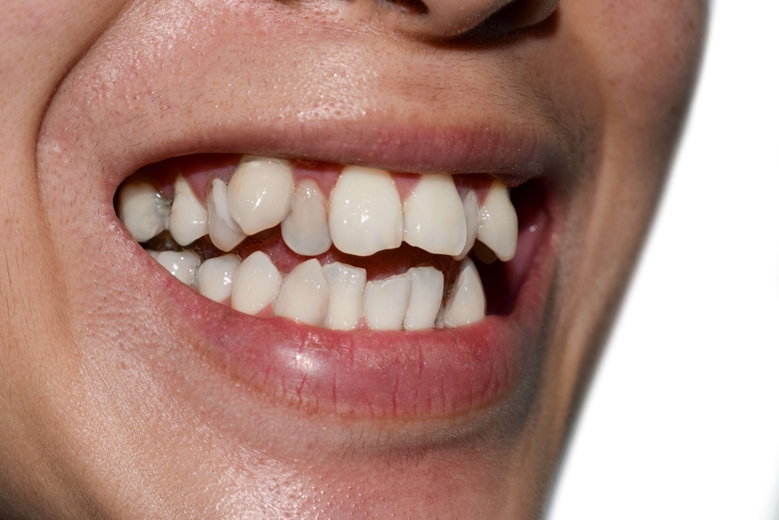 Invisalign for Crowded Teeth: Clear Aligner Solution